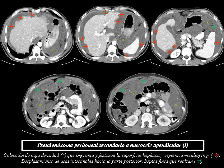 * * * * * * Pseudomixoma peritoneal secundario a mucocele apendicular (I) Colección * * * * * * Pseudomixoma peritoneal secundario a mucocele apendicular (I) Colección