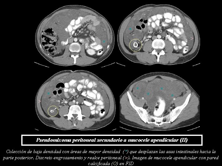 * > * * * * Pseudomixoma peritoneal secundario a mucocele apendicular (II) Colección * > * * * * Pseudomixoma peritoneal secundario a mucocele apendicular (II) Colección