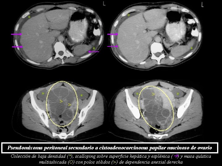 * * > * * * > Pseudomixoma peritoneal secundario a cistoadenocarcinoma papilar mucinoso * * > * * * > Pseudomixoma peritoneal secundario a cistoadenocarcinoma papilar mucinoso