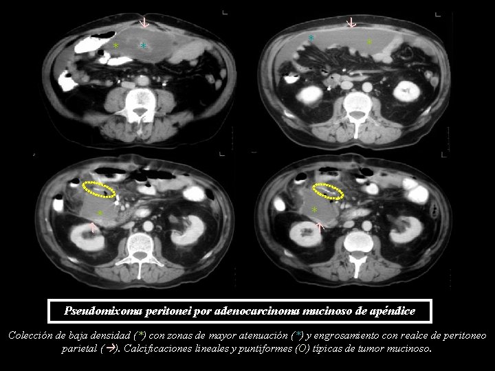 * * * * Pseudomixoma peritonei por adenocarcinoma mucinoso de apéndice Colección de baja * * * * Pseudomixoma peritonei por adenocarcinoma mucinoso de apéndice Colección de baja