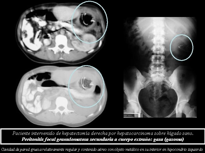 Paciente intervenido de hepatectomía derecha por hepatocarcinoma sobre hígado sano. Peritonitis focal granulomatosa secundaria Paciente intervenido de hepatectomía derecha por hepatocarcinoma sobre hígado sano. Peritonitis focal granulomatosa secundaria