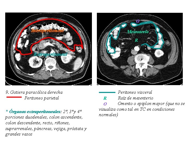 O Intraperitoneal Mesenterio R 9 Retroperitoneal 9. Gotiera paracólica derecha Peritoneo parietal * Órganos O Intraperitoneal Mesenterio R 9 Retroperitoneal 9. Gotiera paracólica derecha Peritoneo parietal * Órganos