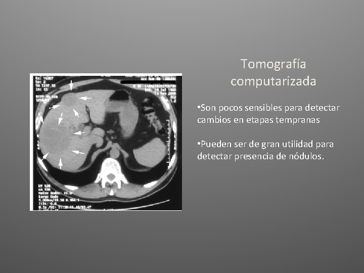 Tomografía computarizada • Son pocos sensibles para detectar cambios en etapas tempranas • Pueden Tomografía computarizada • Son pocos sensibles para detectar cambios en etapas tempranas • Pueden