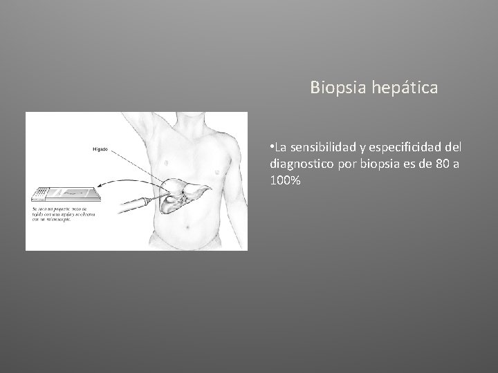 Biopsia hepática • La sensibilidad y especificidad del diagnostico por biopsia es de 80 Biopsia hepática • La sensibilidad y especificidad del diagnostico por biopsia es de 80