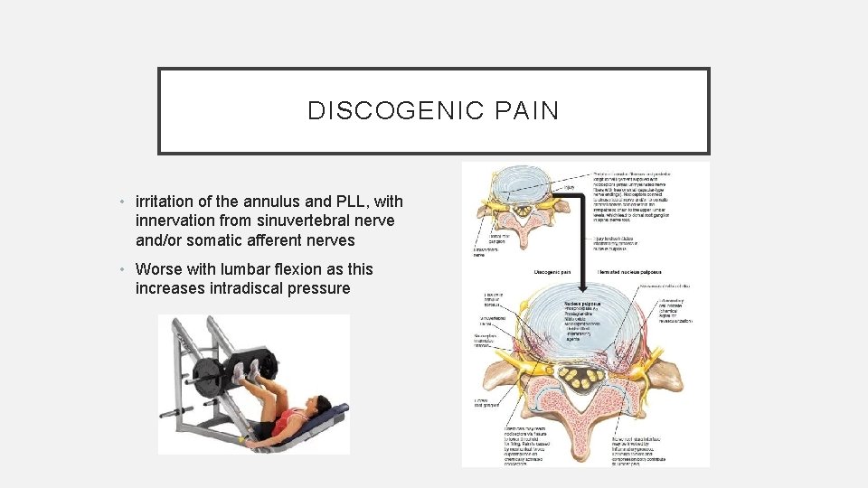DISCOGENIC PAIN • irritation of the annulus and PLL, with innervation from sinuvertebral nerve