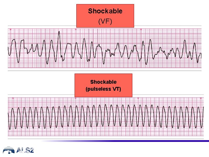 Shockable (VF) Shockable (pulseless VT) 