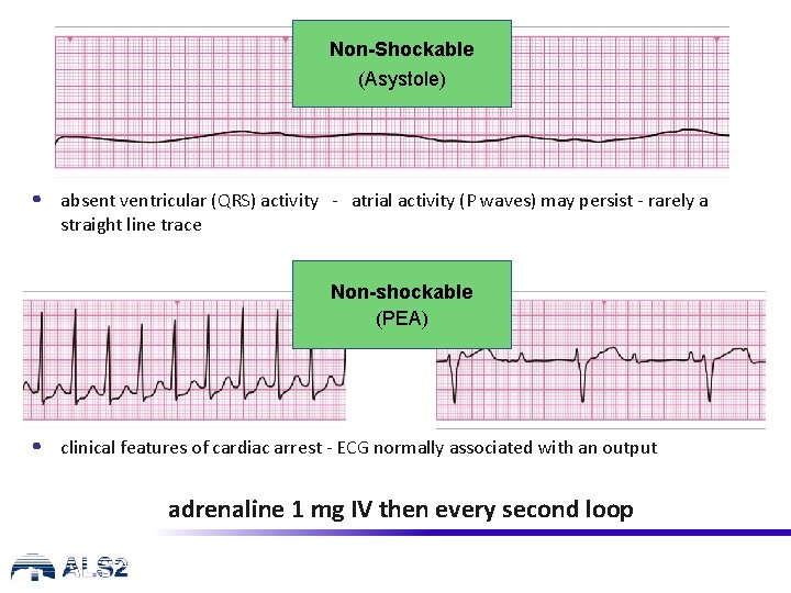 Non-Shockable (Asystole) • absent ventricular (QRS) activity - atrial activity (P waves) may persist