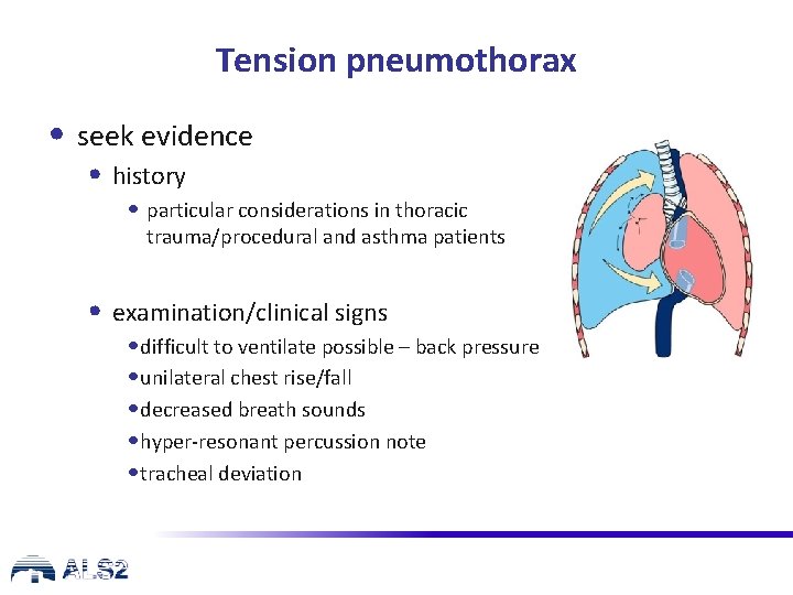 Tension pneumothorax • seek evidence • history • particular considerations in thoracic trauma/procedural and
