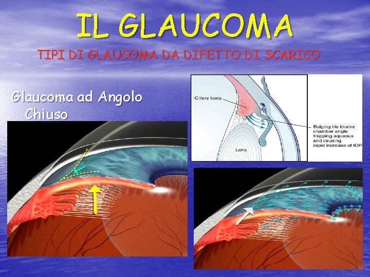 IL GLAUCOMA TIPI DI GLAUCOMA DA DIFETTO DI SCARICO Glaucoma ad Angolo Chiuso 
