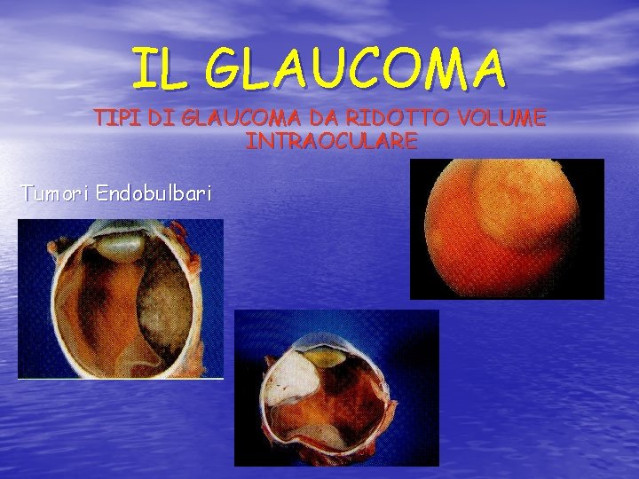 IL GLAUCOMA TIPI DI GLAUCOMA DA RIDOTTO VOLUME INTRAOCULARE Tumori Endobulbari 