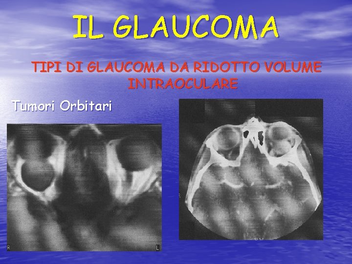 IL GLAUCOMA TIPI DI GLAUCOMA DA RIDOTTO VOLUME INTRAOCULARE Tumori Orbitari 