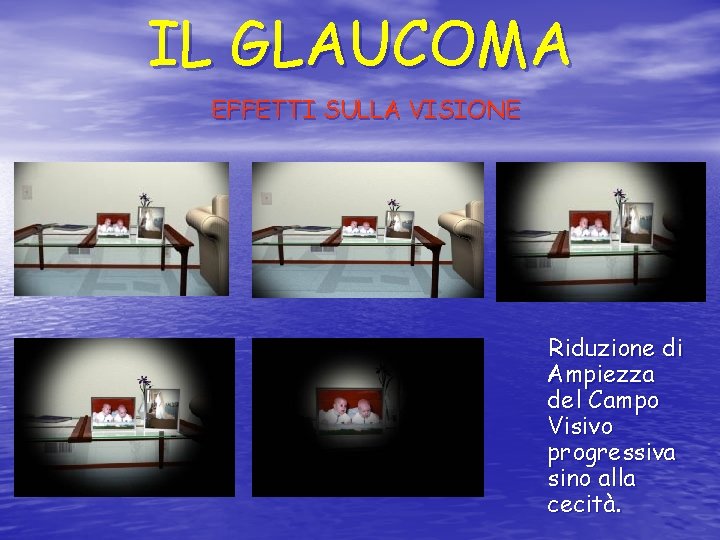 IL GLAUCOMA EFFETTI SULLA VISIONE Riduzione di Ampiezza del Campo Visivo progressiva sino alla