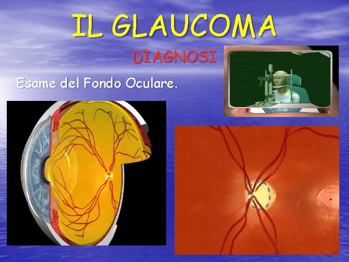 IL GLAUCOMA DIAGNOSI Esame del Fondo Oculare. 
