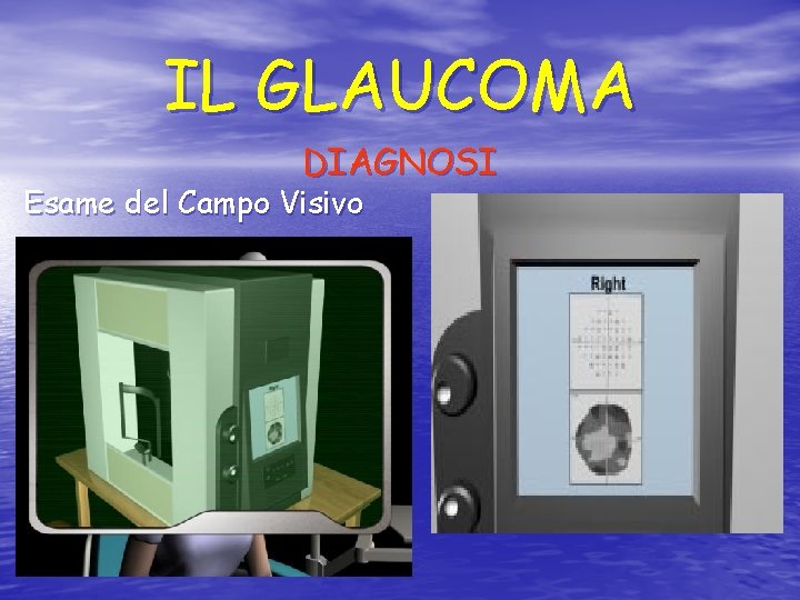 IL GLAUCOMA DIAGNOSI Esame del Campo Visivo 