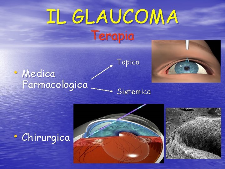 IL GLAUCOMA Terapia • Medica Farmacologica • Chirurgica Topica Sistemica 