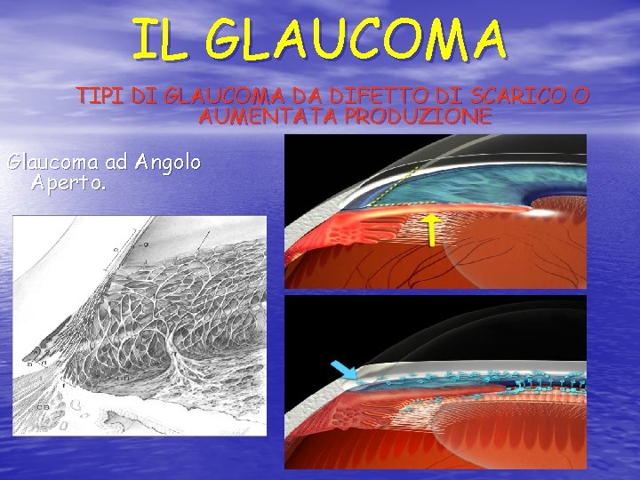 IL GLAUCOMA TIPI DI GLAUCOMA DA DIFETTO DI SCARICO O AUMENTATA PRODUZIONE Glaucoma ad