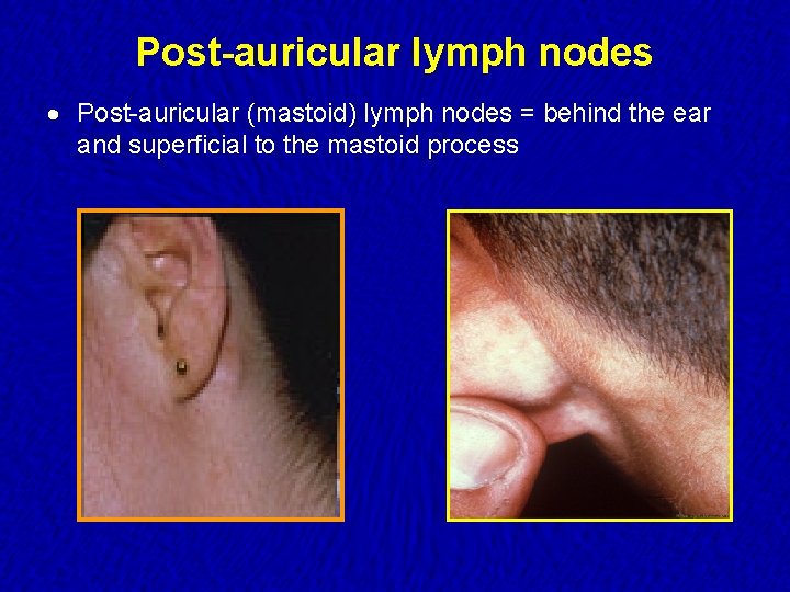 Post-auricular lymph nodes · Post-auricular (mastoid) lymph nodes = behind the ear and superficial