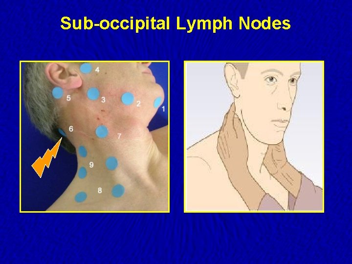 Sub-occipital Lymph Nodes 