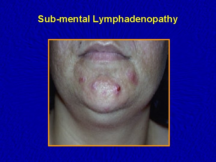 Sub-mental Lymphadenopathy 