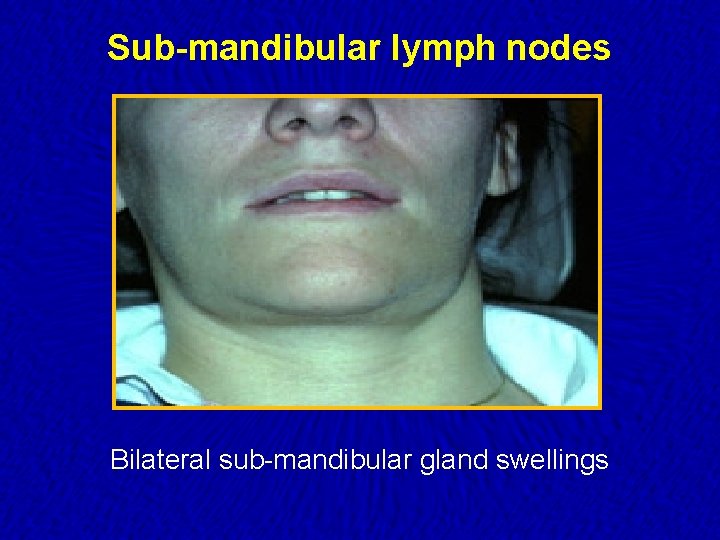 Sub-mandibular lymph nodes Bilateral sub-mandibular gland swellings 