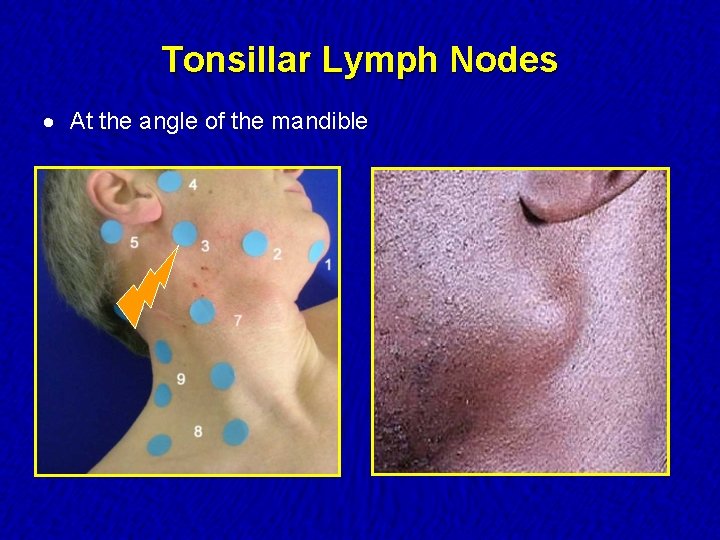 Tonsillar Lymph Nodes · At the angle of the mandible 