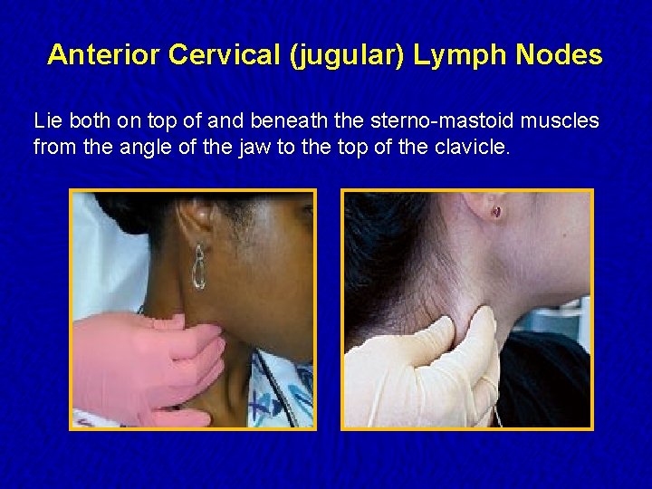 Anterior Cervical (jugular) Lymph Nodes Lie both on top of and beneath the sterno-mastoid