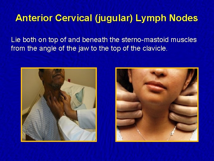 Anterior Cervical (jugular) Lymph Nodes Lie both on top of and beneath the sterno-mastoid