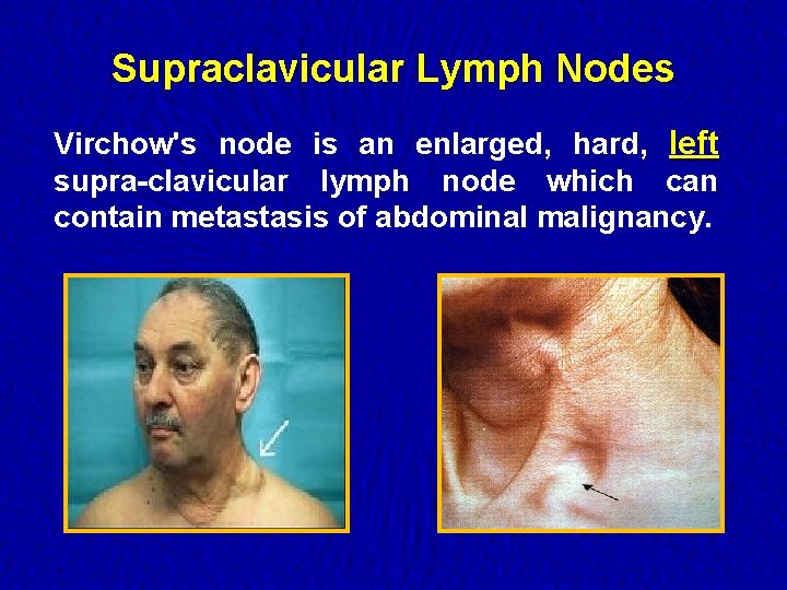 Supraclavicular Lymph Nodes Virchow's node is an enlarged, hard, left supra-clavicular lymph node which