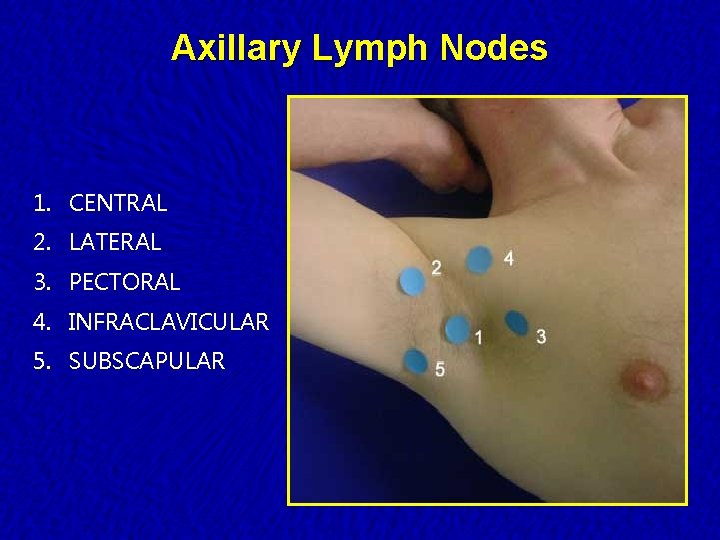 Axillary Lymph Nodes 1. CENTRAL 2. LATERAL 3. PECTORAL 4. INFRACLAVICULAR 5. SUBSCAPULAR 