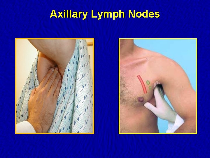 Axillary Lymph Nodes 