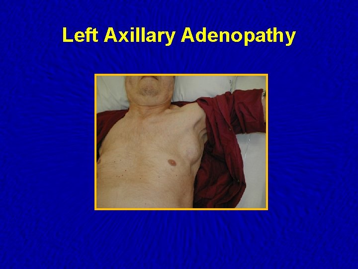 Left Axillary Adenopathy 