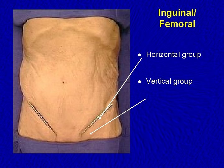 Inguinal/ Femoral · Horizontal group · Vertical group 