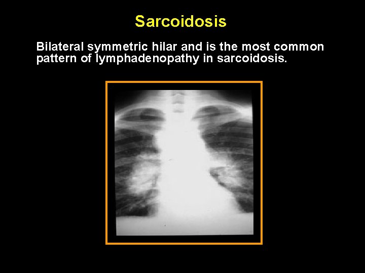 Sarcoidosis Bilateral symmetric hilar and is the most common pattern of lymphadenopathy in sarcoidosis.