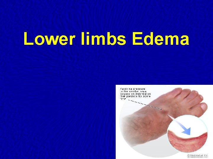 Lower limbs Edema 