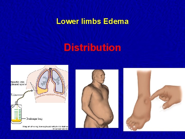 Lower limbs Edema Distribution 