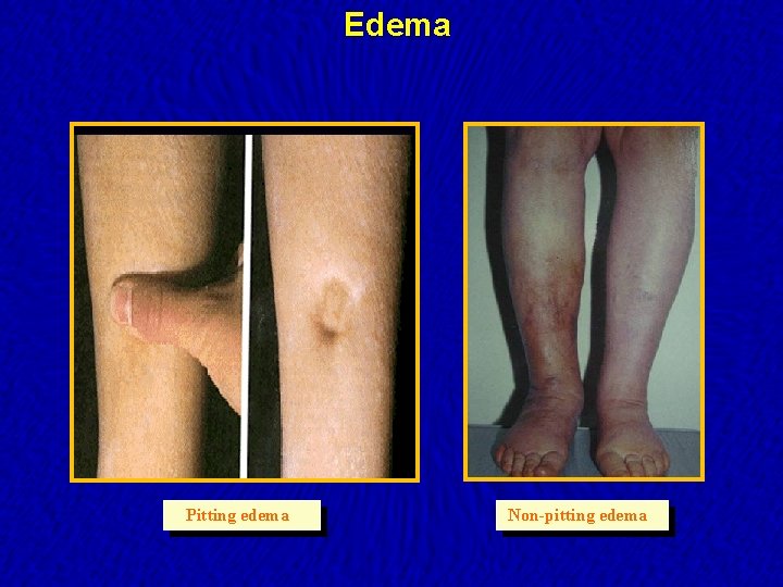 Edema Pitting edema Non-pitting edema 