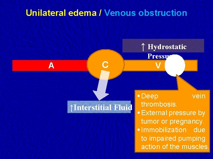 Unilateral edema / Venous obstruction ↑ Hydrostatic A C Pressure V § Deep vein