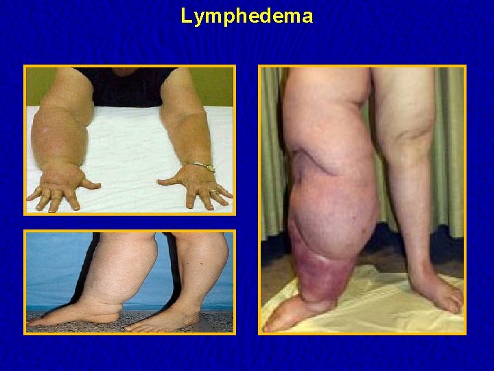 Lymphedema 