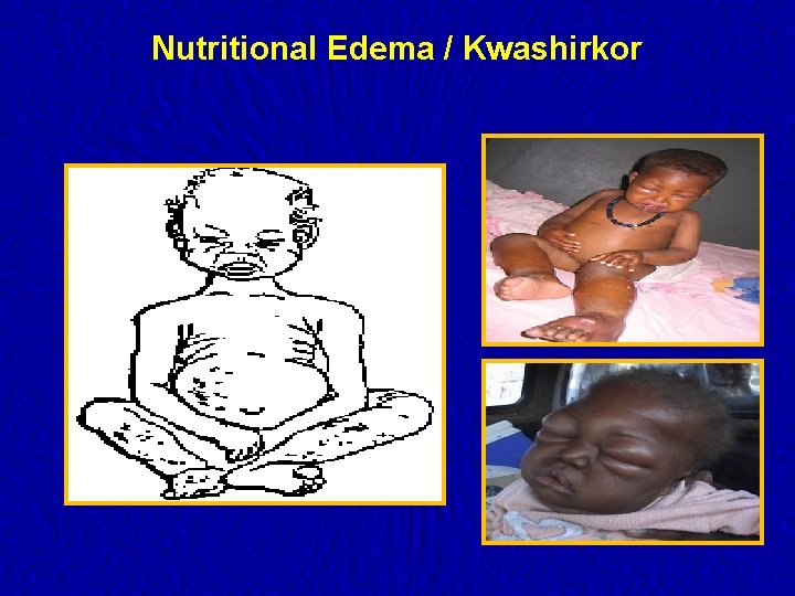 Nutritional Edema / Kwashirkor 