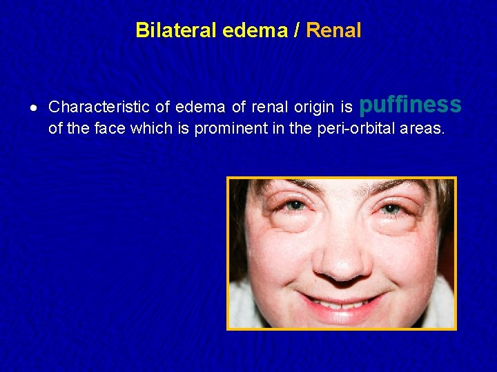 Bilateral edema / Renal · Characteristic of edema of renal origin is puffiness of