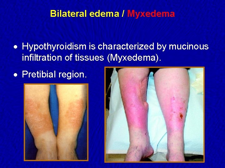 Bilateral edema / Myxedema · Hypothyroidism is characterized by mucinous infiltration of tissues (Myxedema).