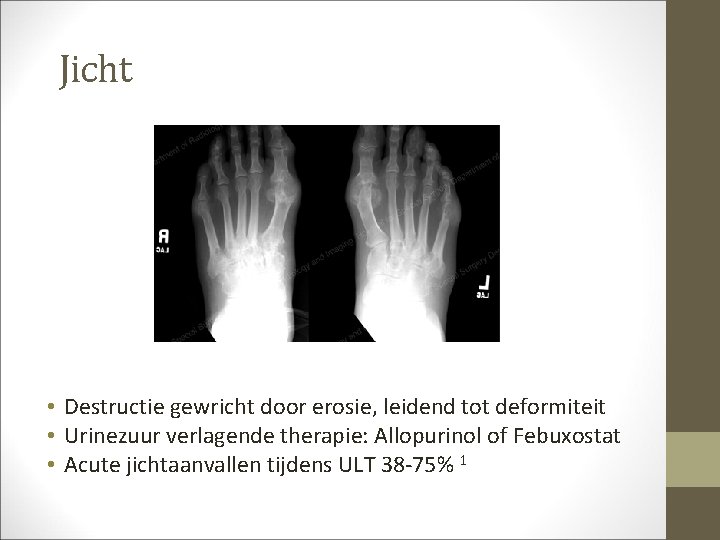 Jicht • Destructie gewricht door erosie, leidend tot deformiteit • Urinezuur verlagende therapie: Allopurinol