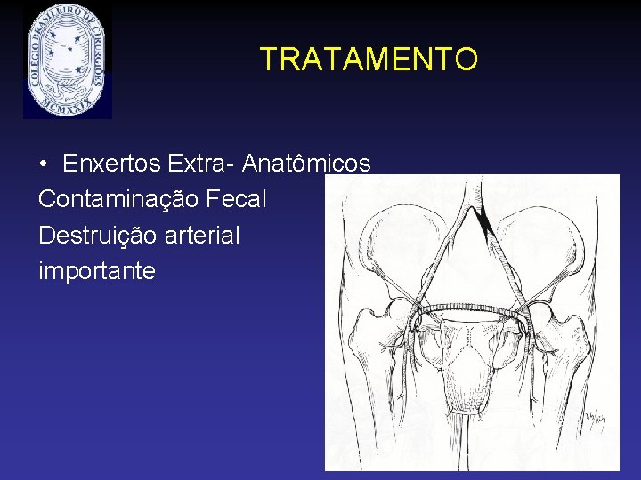 TRATAMENTO • Enxertos Extra- Anatômicos Contaminação Fecal Destruição arterial importante 