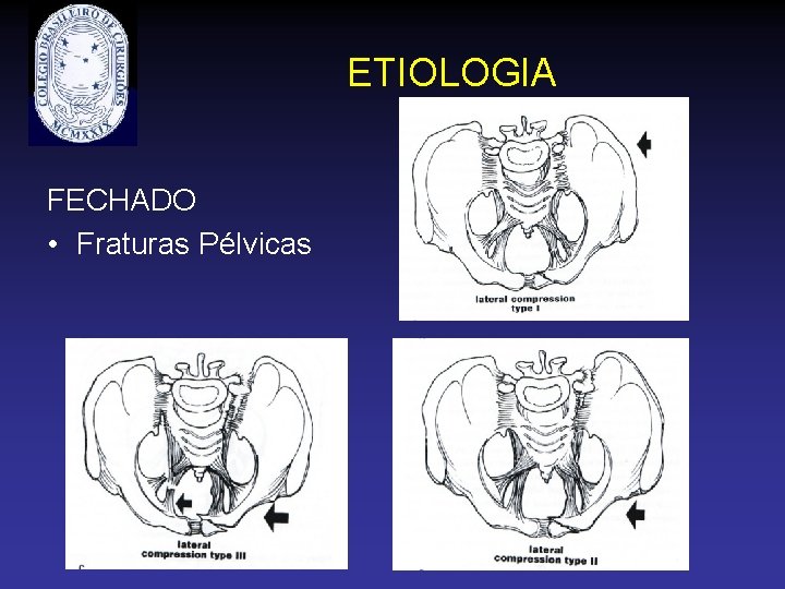 ETIOLOGIA FECHADO • Fraturas Pélvicas 