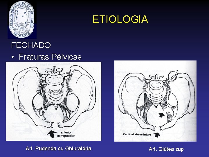 ETIOLOGIA FECHADO • Fraturas Pélvicas Art. Pudenda ou Obturatória Art. Glútea sup 