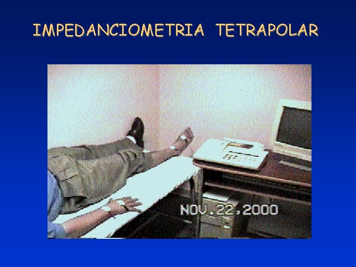 IMPEDANCIOMETRIA TETRAPOLAR 