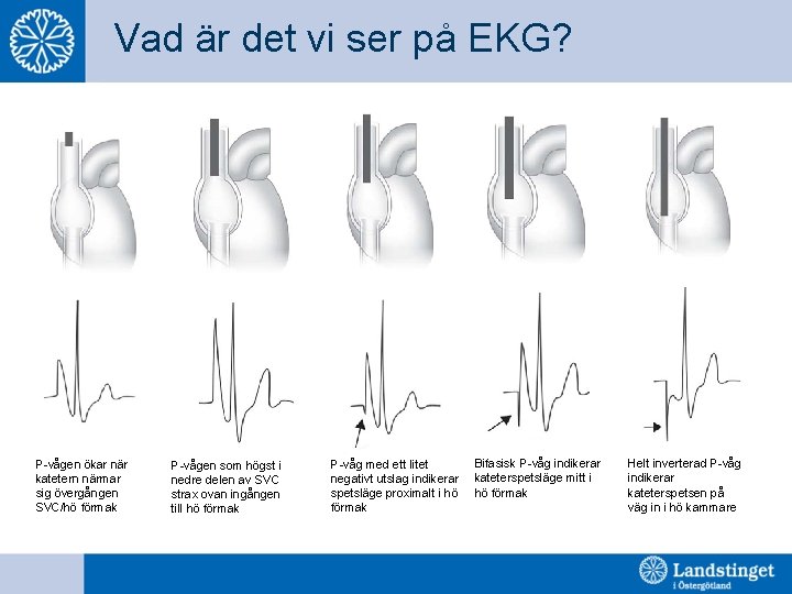 Vad är det vi ser på EKG? P-vågen ökar när katetern närmar sig övergången