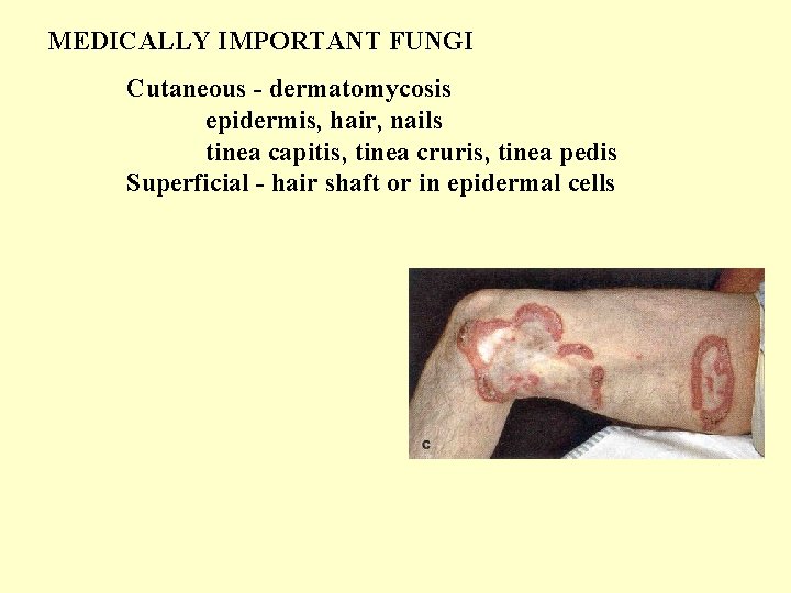 MEDICALLY IMPORTANT FUNGI Cutaneous - dermatomycosis epidermis, hair, nails tinea capitis, tinea cruris, tinea