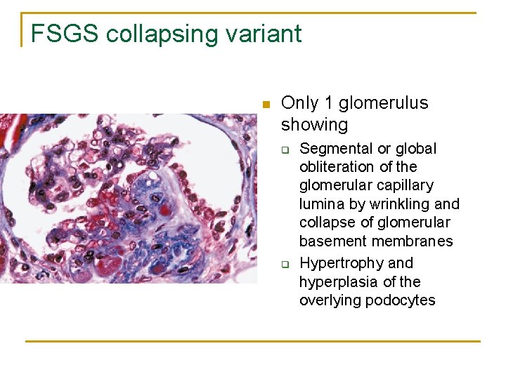 FSGS collapsing variant n Only 1 glomerulus showing q q Segmental or global obliteration FSGS collapsing variant n Only 1 glomerulus showing q q Segmental or global obliteration