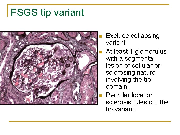 FSGS tip variant n n n Exclude collapsing variant At least 1 glomerulus with FSGS tip variant n n n Exclude collapsing variant At least 1 glomerulus with